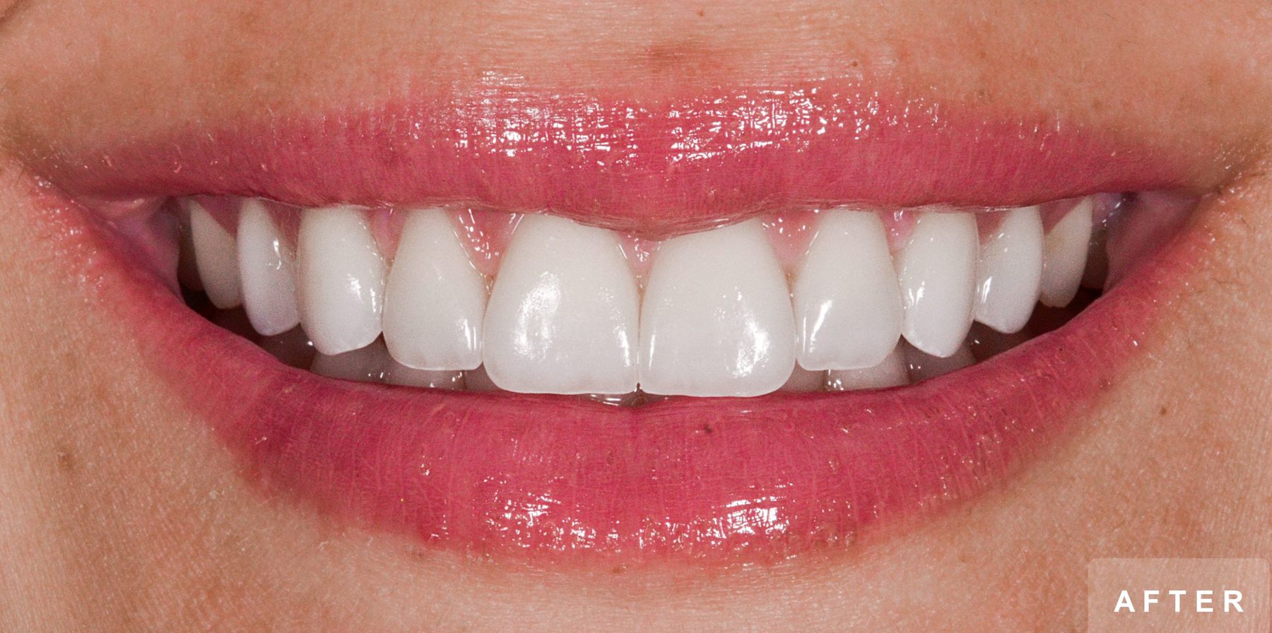 Smile after treatment: porcelain veneers on the upper front teeth