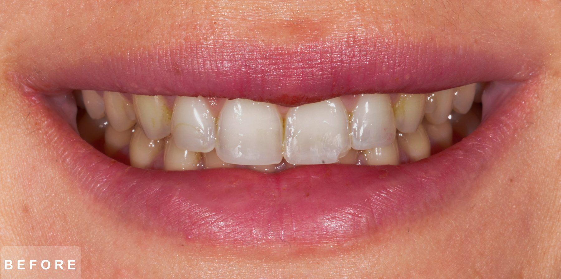 Smile before treatment: worn, discoloured and uneven upper front teeth
