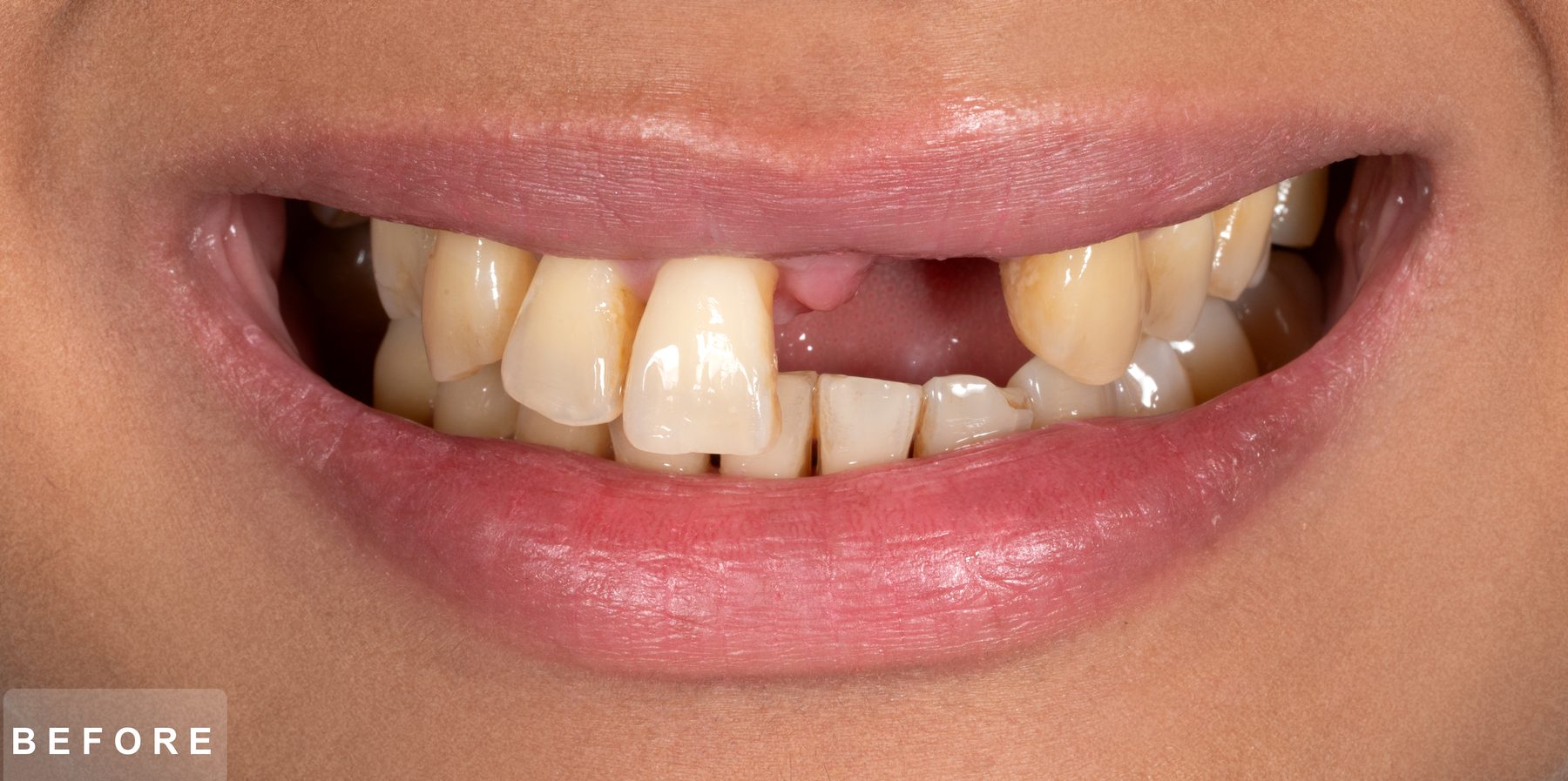 Smile before treatment: missing upper front tooth, worn and discoloured teeth