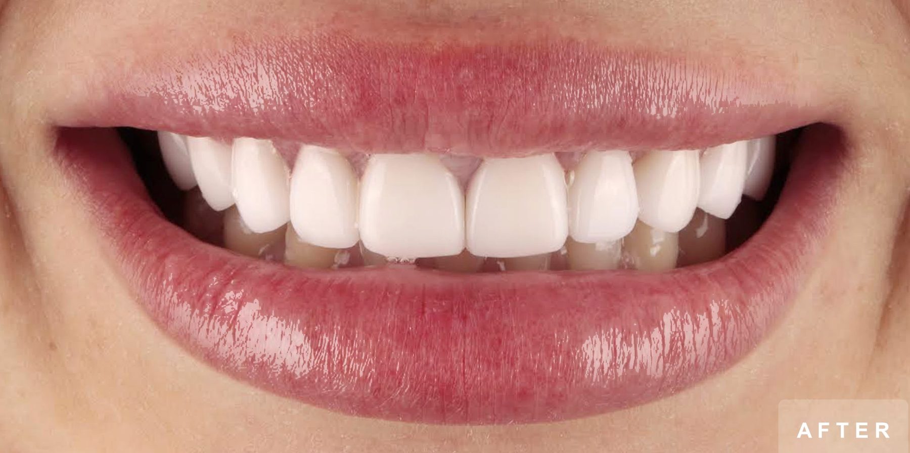 Smile after treatment: bright, even upper front teeth