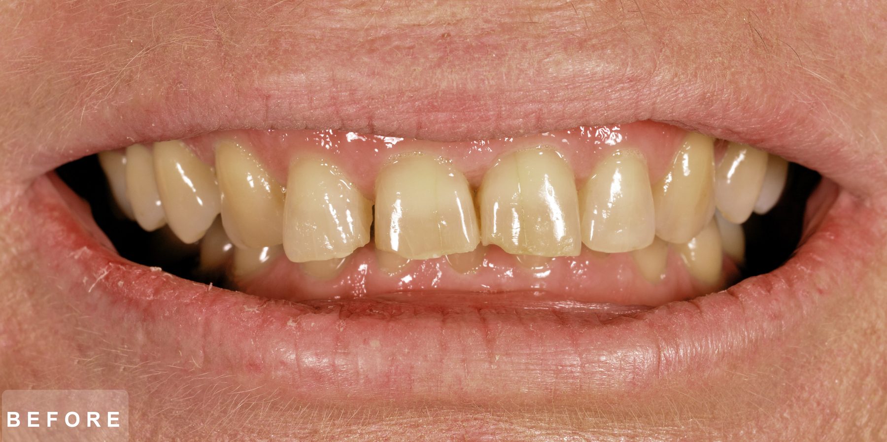 Smile before treatment: worn, yellowed and uneven upper front teeth