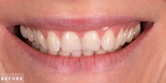 Smile before treatment: uneven, slightly discoloured upper front teeth with a gummy smile