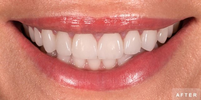 Smile after treatment: bright, even upper front teeth