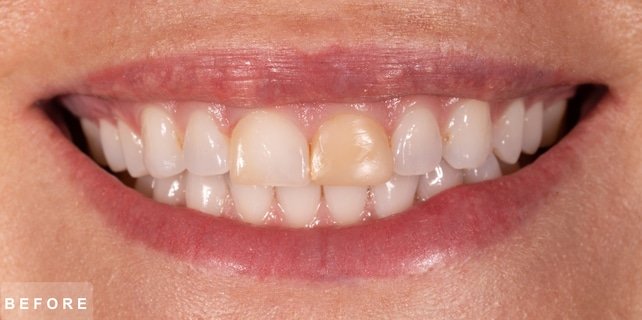 Smile before treatment: discoloured front tooth and uneven upper teeth