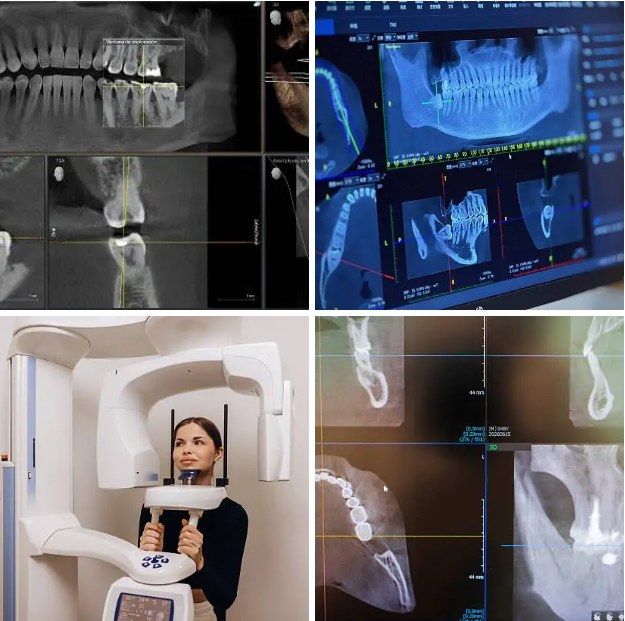 CBCT (cone beam CT) 3D dental imaging used in wisdom teeth assessment — Dr Pierre Dentistry Edgecliff