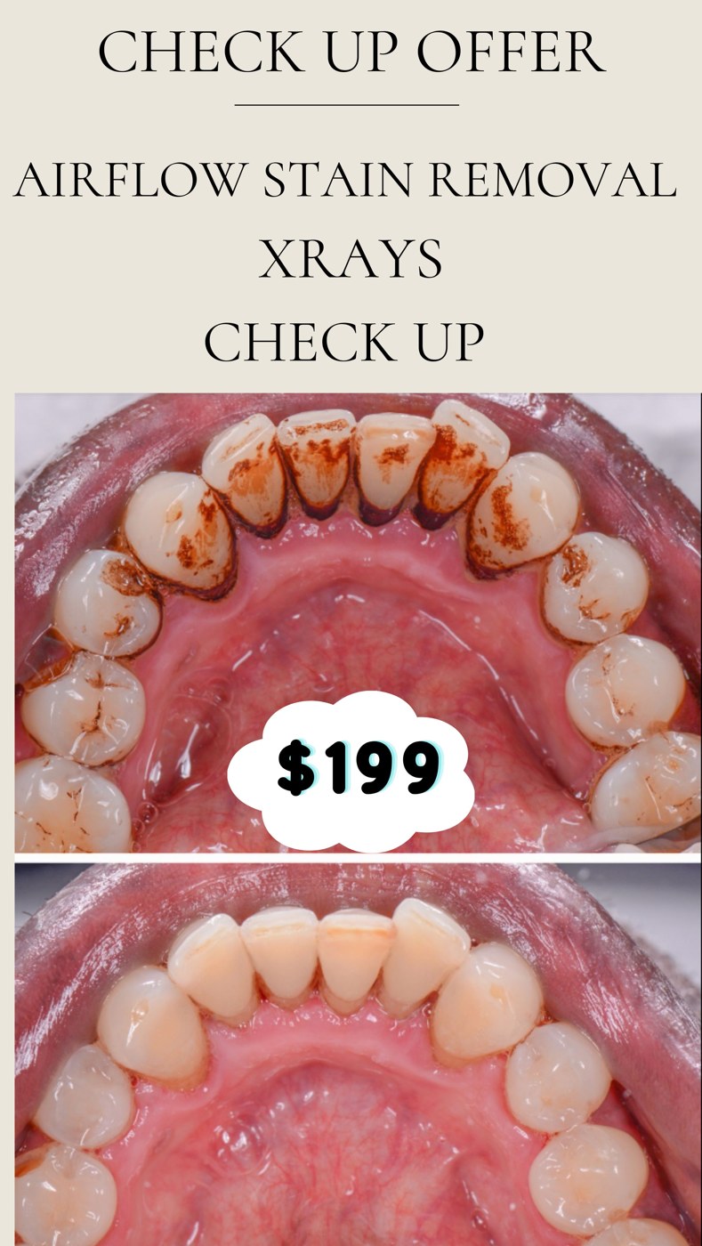 $199 check-up offer — airflow stain removal, X-rays and check-up. Actual patient before and after stain removal; individual results vary. Terms and conditions apply.