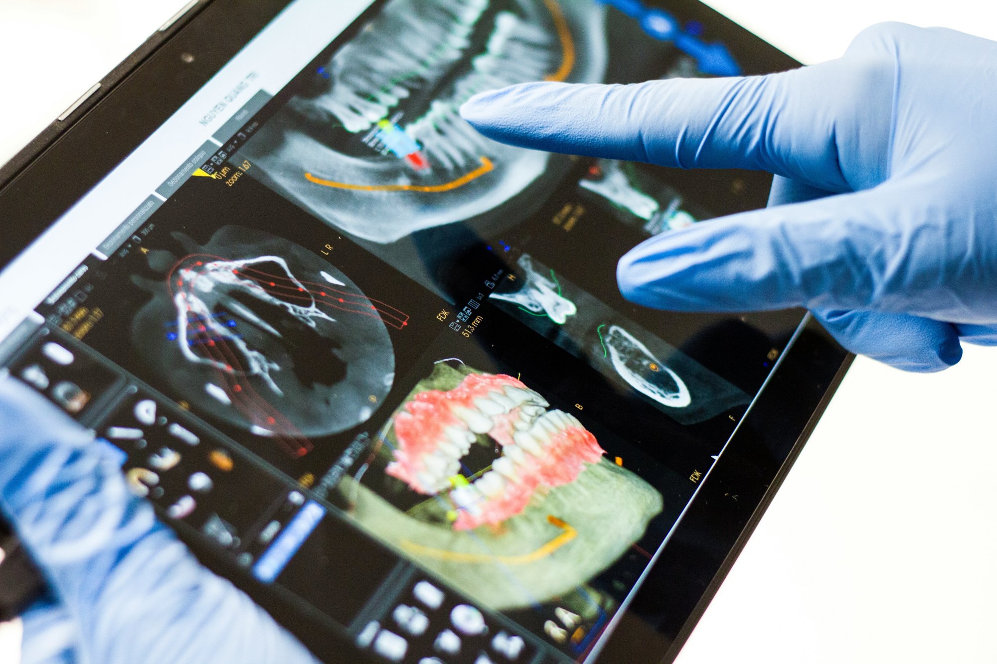Dentist reviewing 3D dental implant imaging on a tablet — Dr Pierre Dentistry Edgecliff