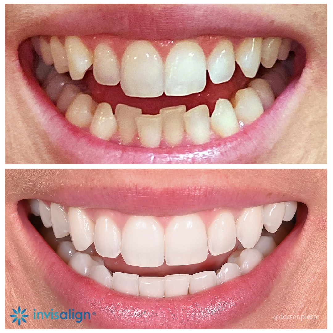 Before and after Invisalign clear aligner treatment — an actual patient of Dr Pierre Khazin, Edgecliff