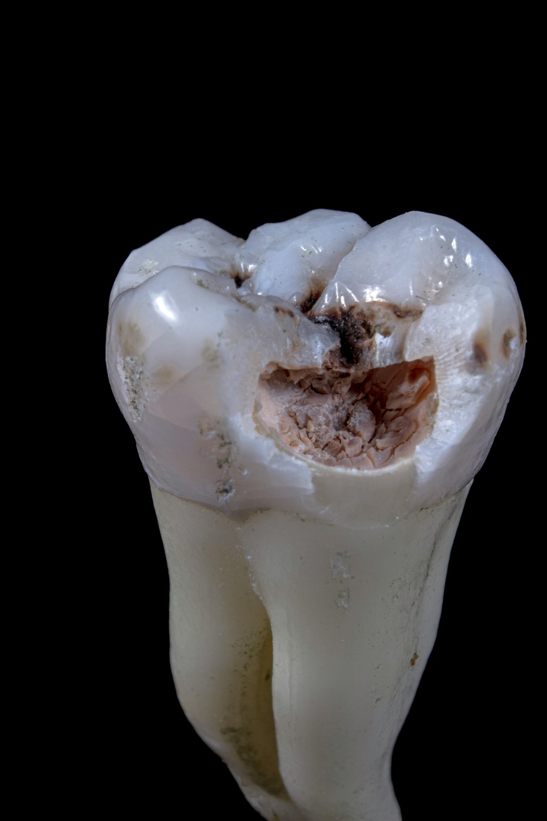 Extracted molar showing untreated tooth decay — why fillings are indicated
