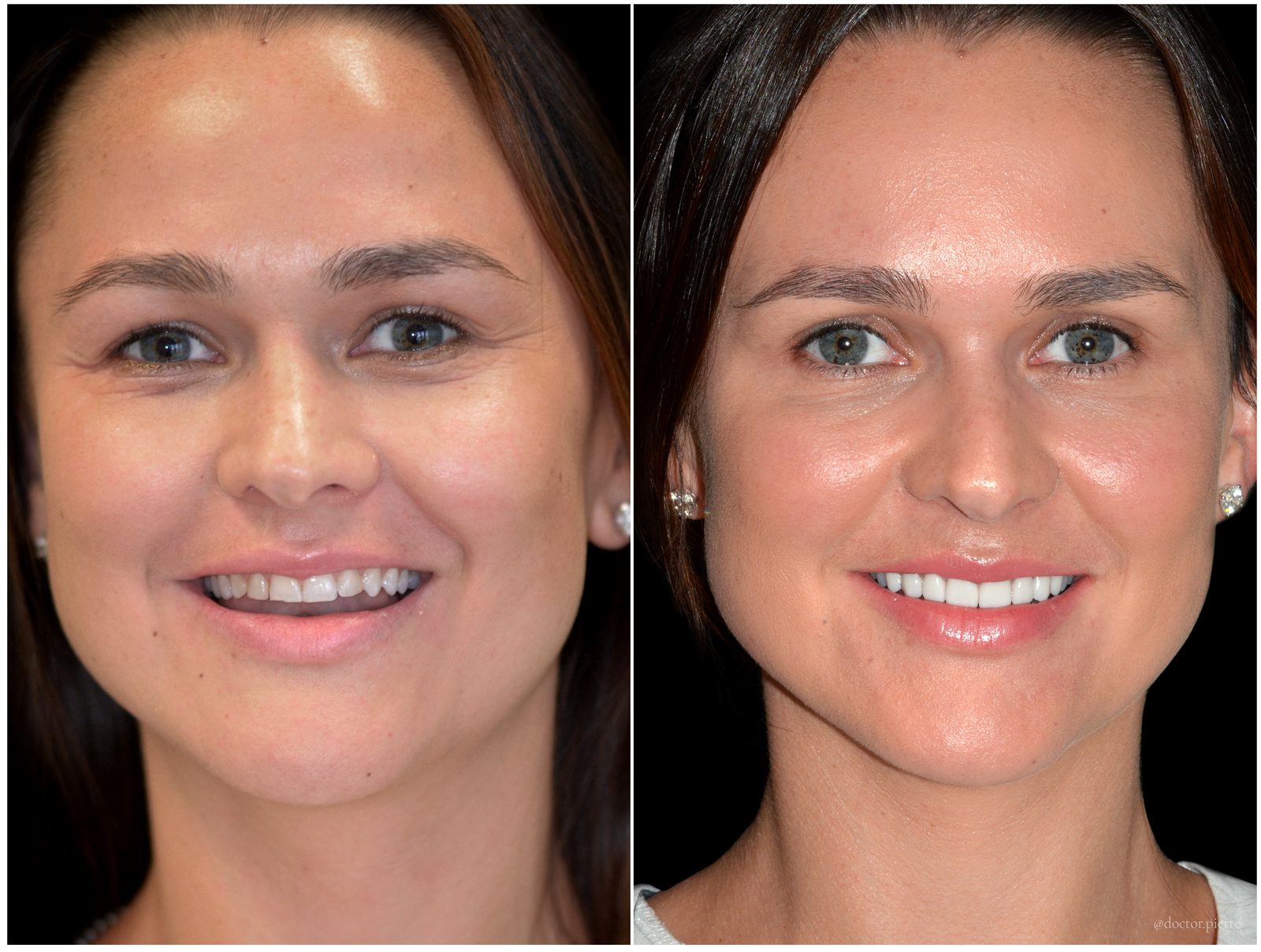 Before and after porcelain veneers — an actual patient of Dr Pierre Khazin, Edgecliff
