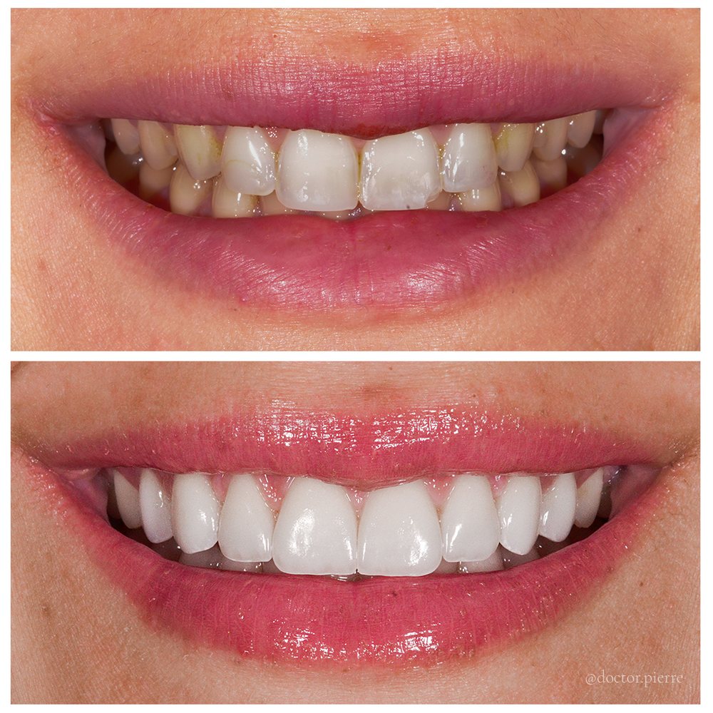 Before and after porcelain veneers, close-up — an actual patient of Dr Pierre Khazin, Edgecliff