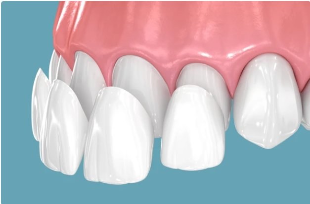 Porcelain dental veneers illustration