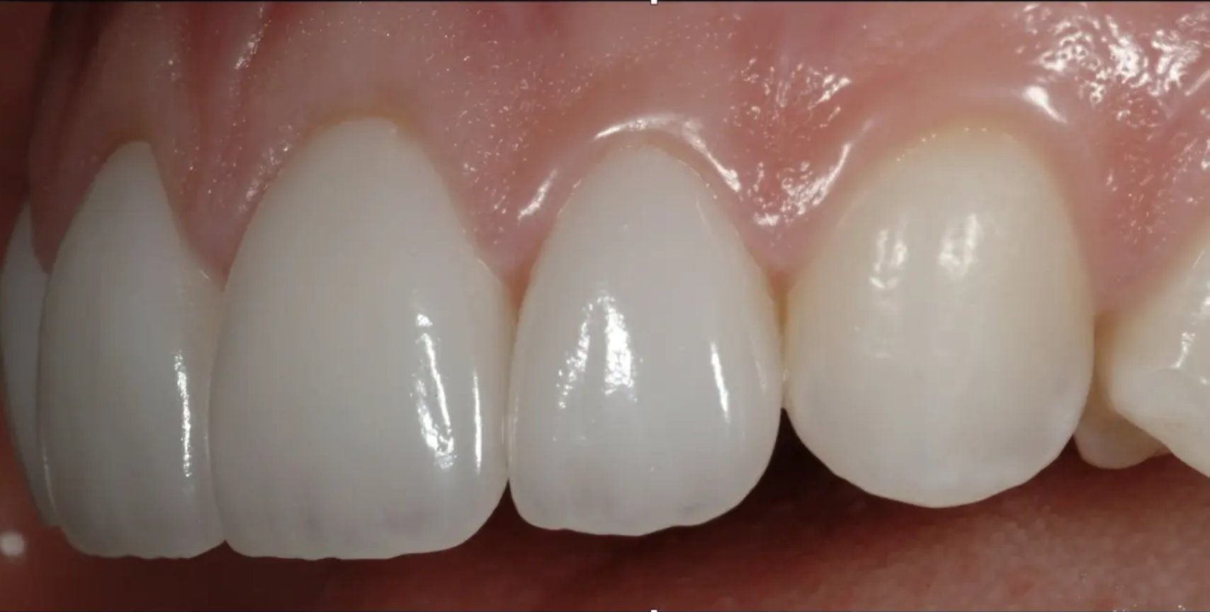Close-up of porcelain veneers on upper front teeth. Individual results vary; published with patient consent