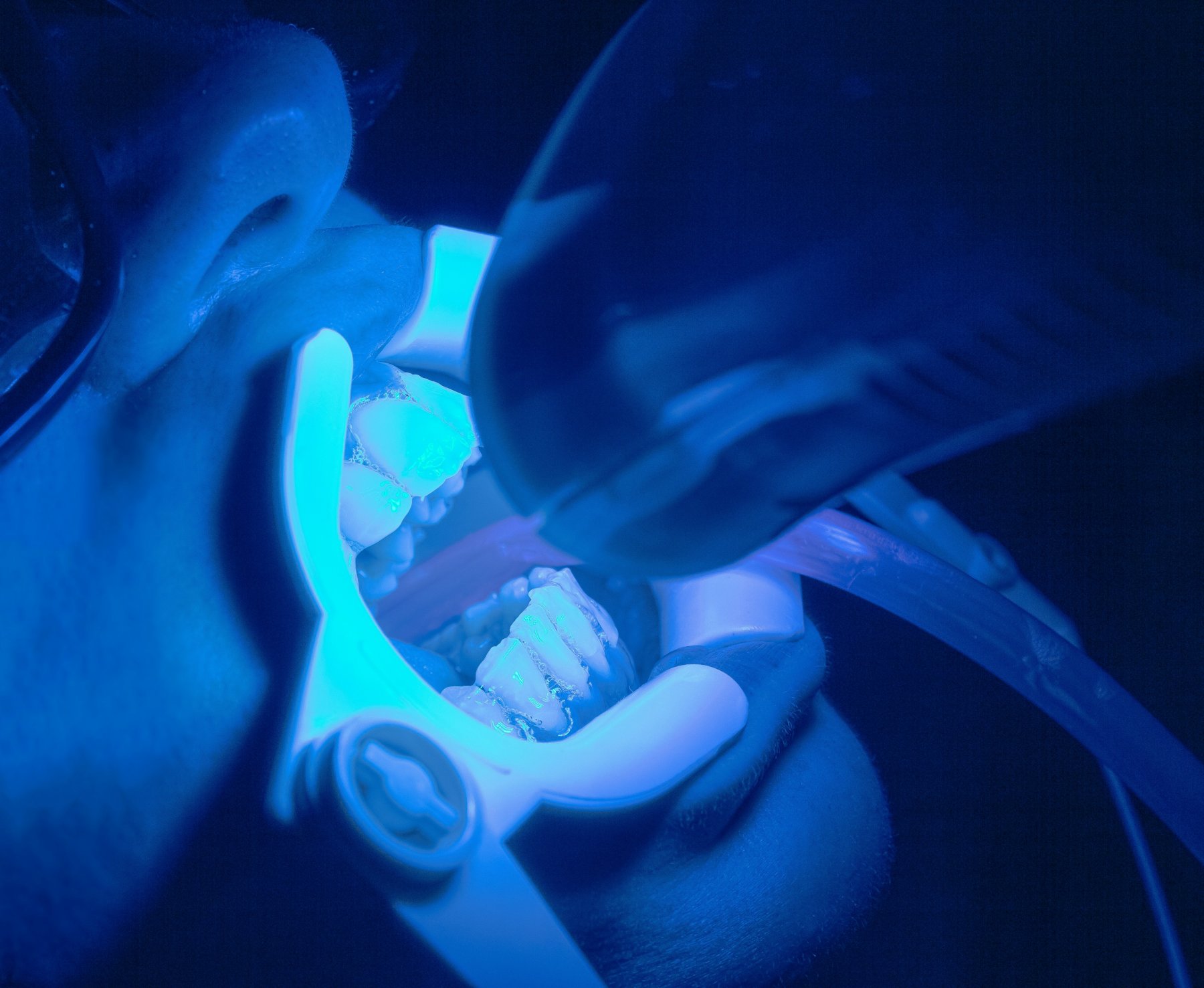 In-chair teeth whitening with light activation — Dr Pierre Dentistry Edgecliff