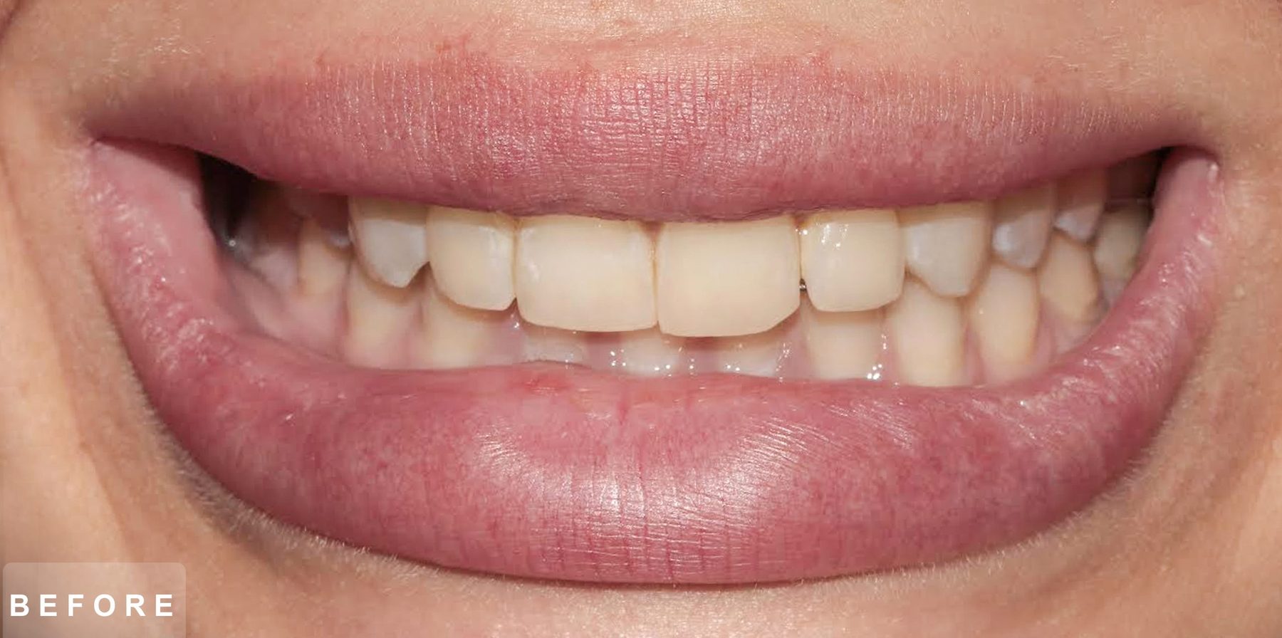 Smile before treatment: yellowed, worn and uneven upper front teeth