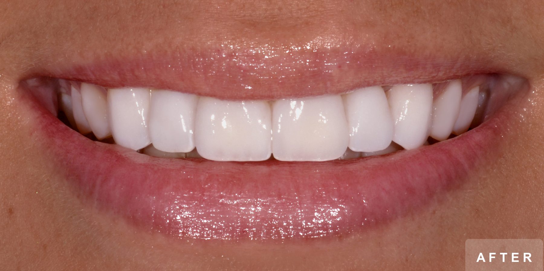 Smile after treatment: bright, even upper front teeth