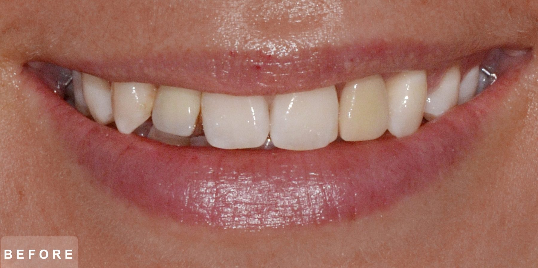 Smile before treatment: uneven, slightly discoloured upper front teeth