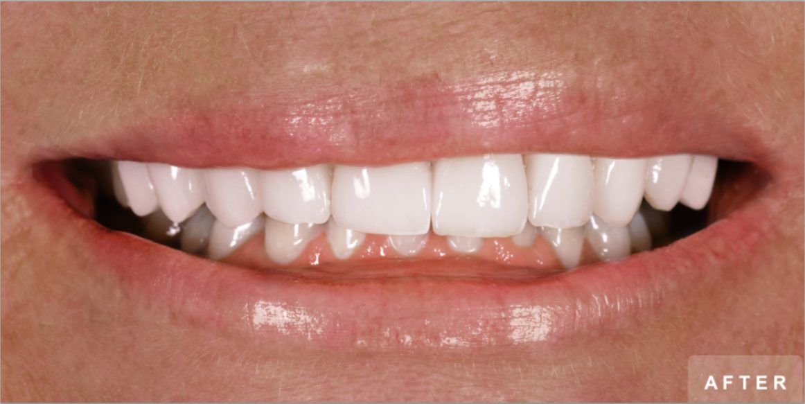Smile after treatment: bright, even upper front teeth