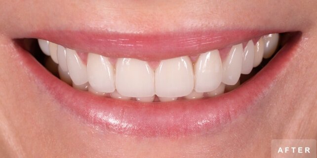 After treatment