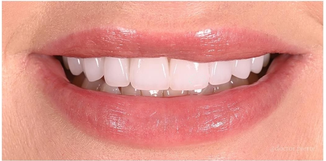 After treatment
