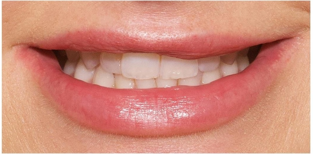 Before treatment