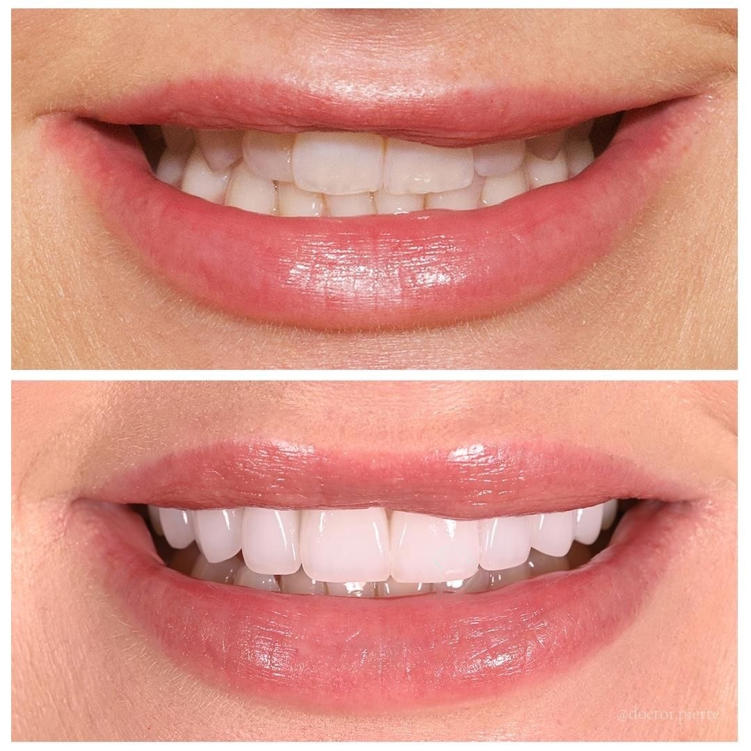 Veneer clinical case, before and after — Dr Pierre Dentistry Edgecliff